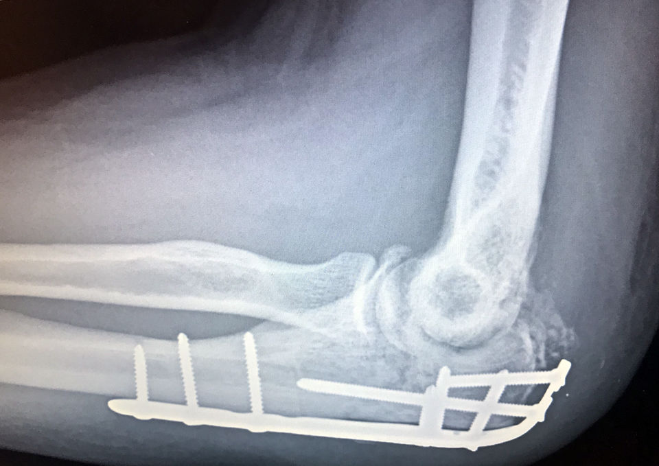 Brent elbow X-ray
